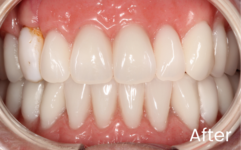 Full front retracted view of transformation after with dental implant stabilised dentures