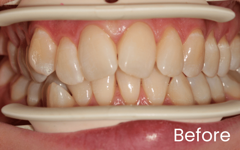 Straight Teeth Options - Hampshire Dentists Pain Free Dentist in Southampton Close up retracted view of teeth showing overlapping and discolouration before dental treatment at Hampshire Dentists