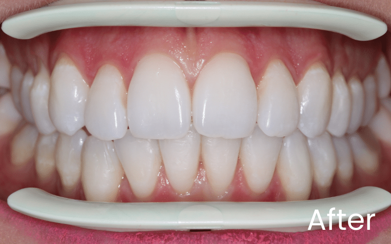 Straight Teeth Options - Hampshire Dentists Pain Free Dentist in Southampton Close up retracted view of teeth following teeth whitening and straightening treatment at Hampshire Dentists