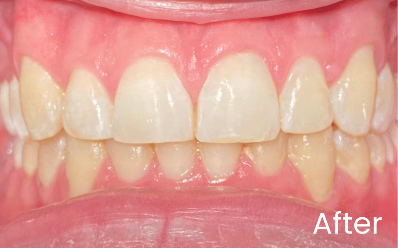 Straight Teeth Options - Hampshire Dentists Pain Free Dentist in Southampton Full front retracted view of teeth after correcting overbite with Invisalign treatment