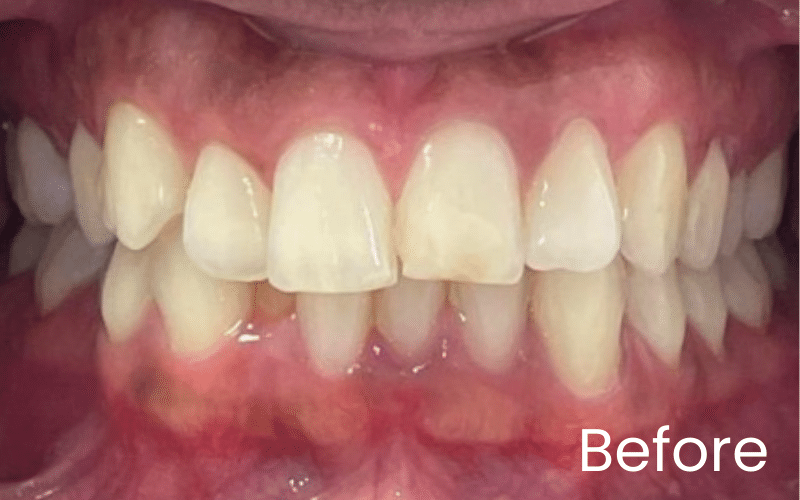 Straight Teeth Options - Hampshire Dentists Pain Free Dentist in Southampton Straight Teeth Options - Hampshire Dentists Pain Free Dentist in Southampton