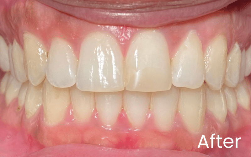 Straight Teeth Options - Hampshire Dentists Pain Free Dentist in Southampton Front full retracted view of teeth after teeth straightening treatment