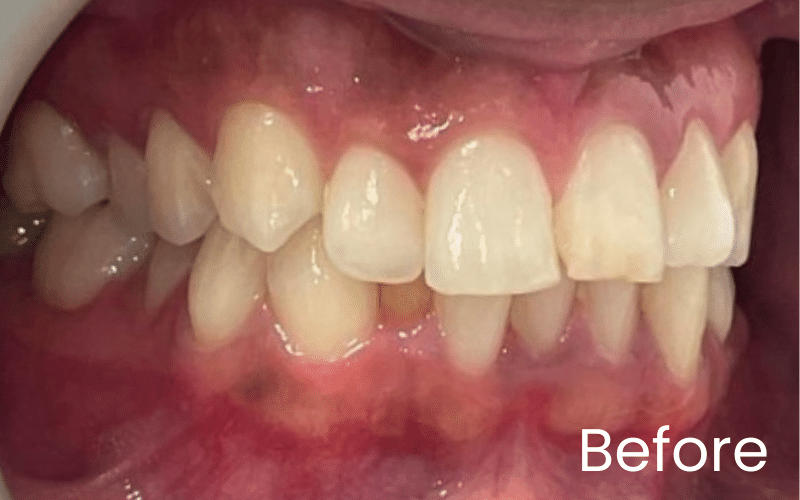 Straight Teeth Options - Hampshire Dentists Pain Free Dentist in Southampton Right retracted view of teeth showing crowding and overbite before straightening treatment