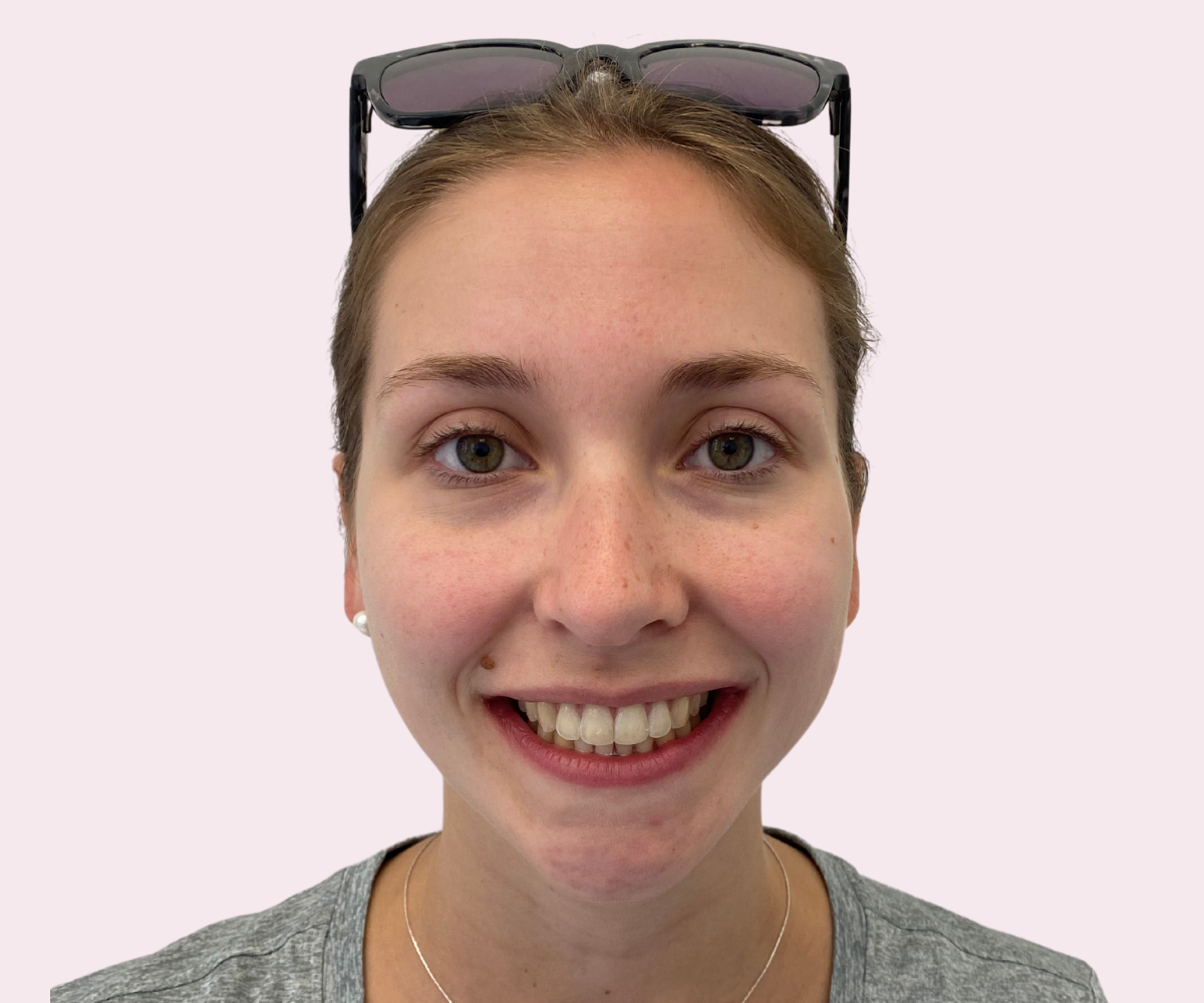 Smile transformations: Before and afters - Hampshire Dentists Pain Free Dentist in Southampton
