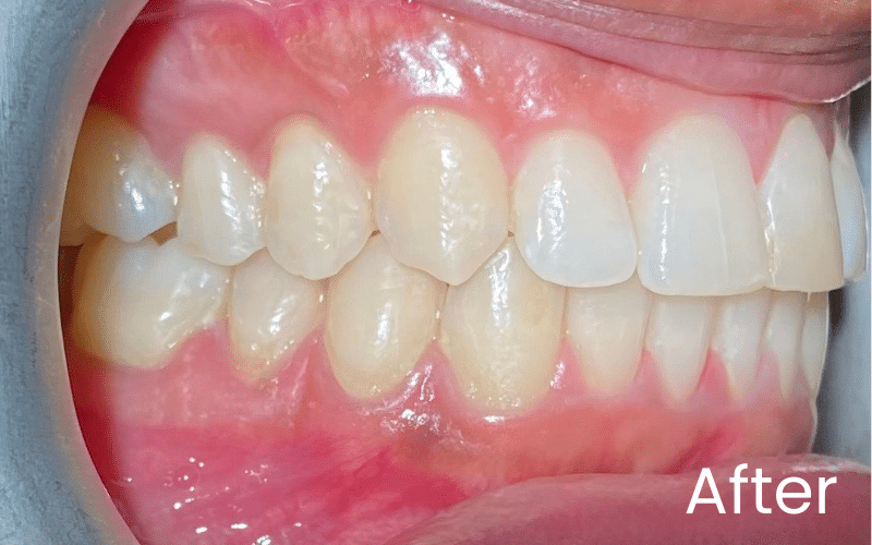 Straight Teeth Options - Hampshire Dentists Pain Free Dentist in Southampton Right retracted view of teeth after straightening treatment