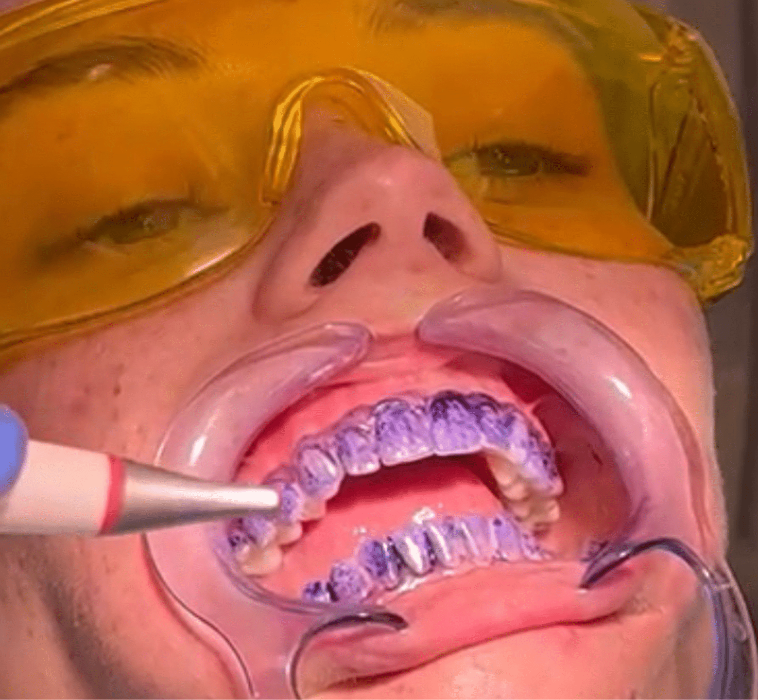 Hygienist - Hampshire Dentists Pain Free Dentist in Southampton Patient with plaque disclosed prior to guided biofilm therapy hygiene with airflow treatment