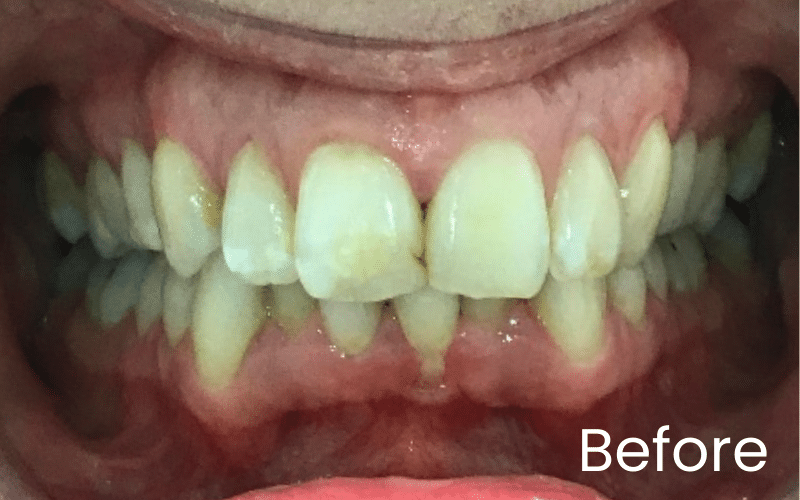 Straight Teeth Options - Hampshire Dentists Pain Free Dentist in Southampton Straight Teeth Options - Hampshire Dentists Pain Free Dentist in Southampton