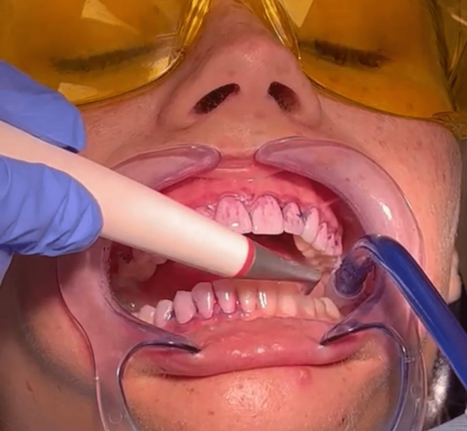 Hygienist - Hampshire Dentists Pain Free Dentist in Southampton Close up of patient undergoing guided biofilm therapy hygiene with airflow treatment