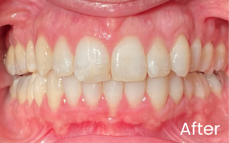 Straight Teeth Options - Hampshire Dentists Pain Free Dentist in Southampton Front full retracted view of teeth after teeth straightening treatment