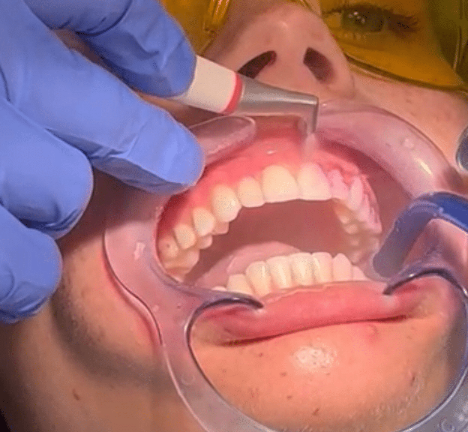 Hygienist - Hampshire Dentists Pain Free Dentist in Southampton Close up of patients mouth at the end of guided biofilm therapy hygiene with airflow treatment
