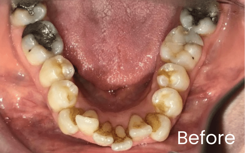 Straight Teeth Options - Hampshire Dentists Pain Free Dentist in Southampton Straight Teeth Options - Hampshire Dentists Pain Free Dentist in Southampton