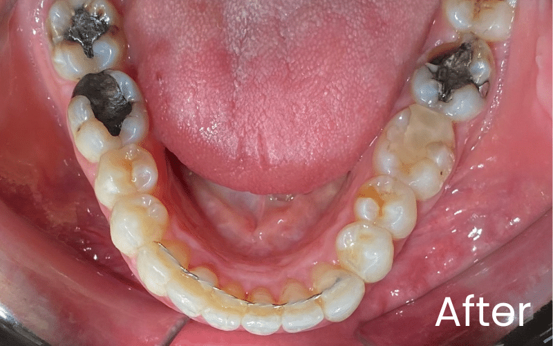 Straight Teeth Options - Hampshire Dentists Pain Free Dentist in Southampton View of all lower teeth and tongue after teeth straightening treatment at Hampshire Dentists, showing fixed retainer in place