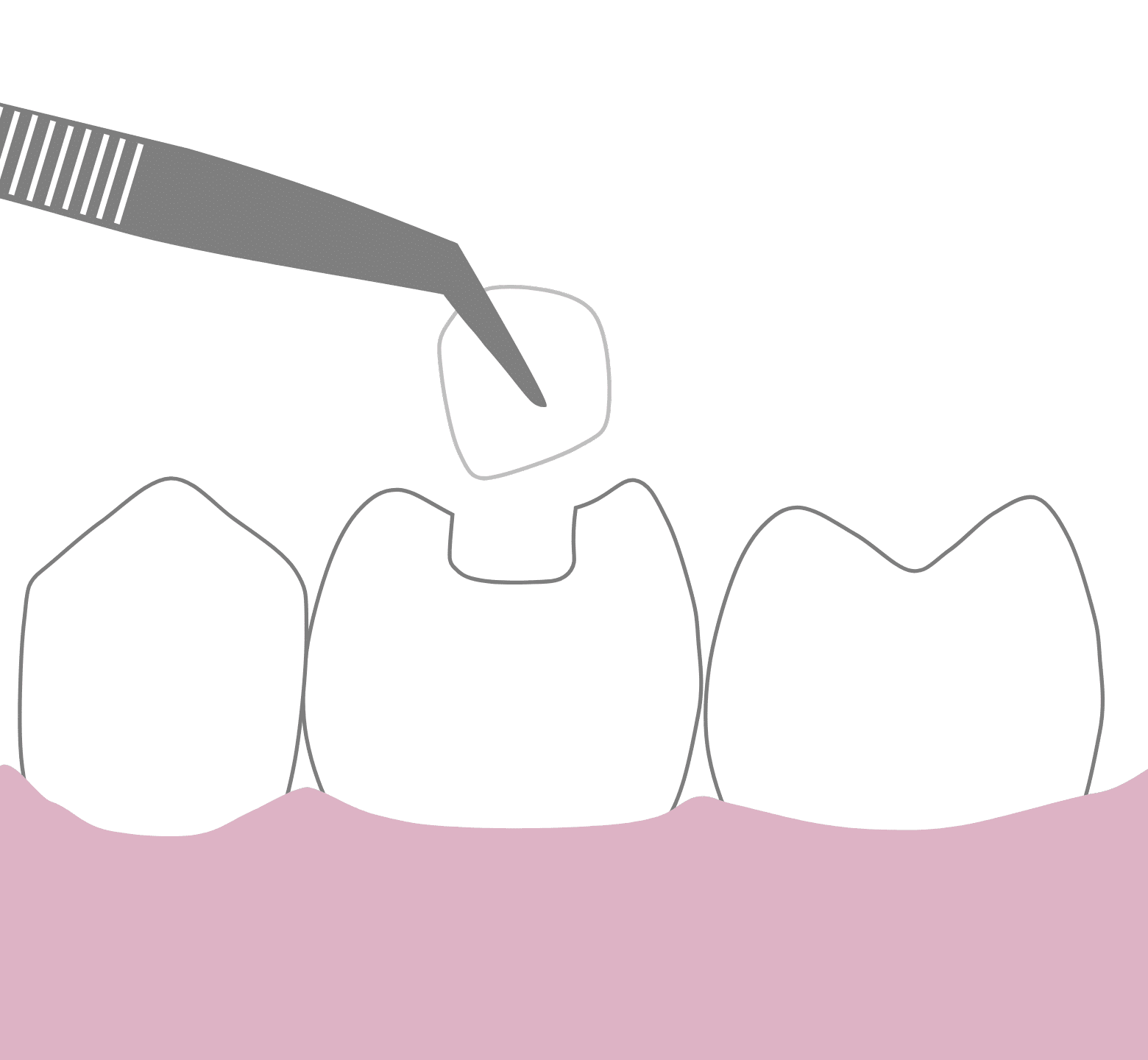 White Fillings - Hampshire Dentists Pain Free Dentist in Southampton Graphic showing second stage of dental filling procedure