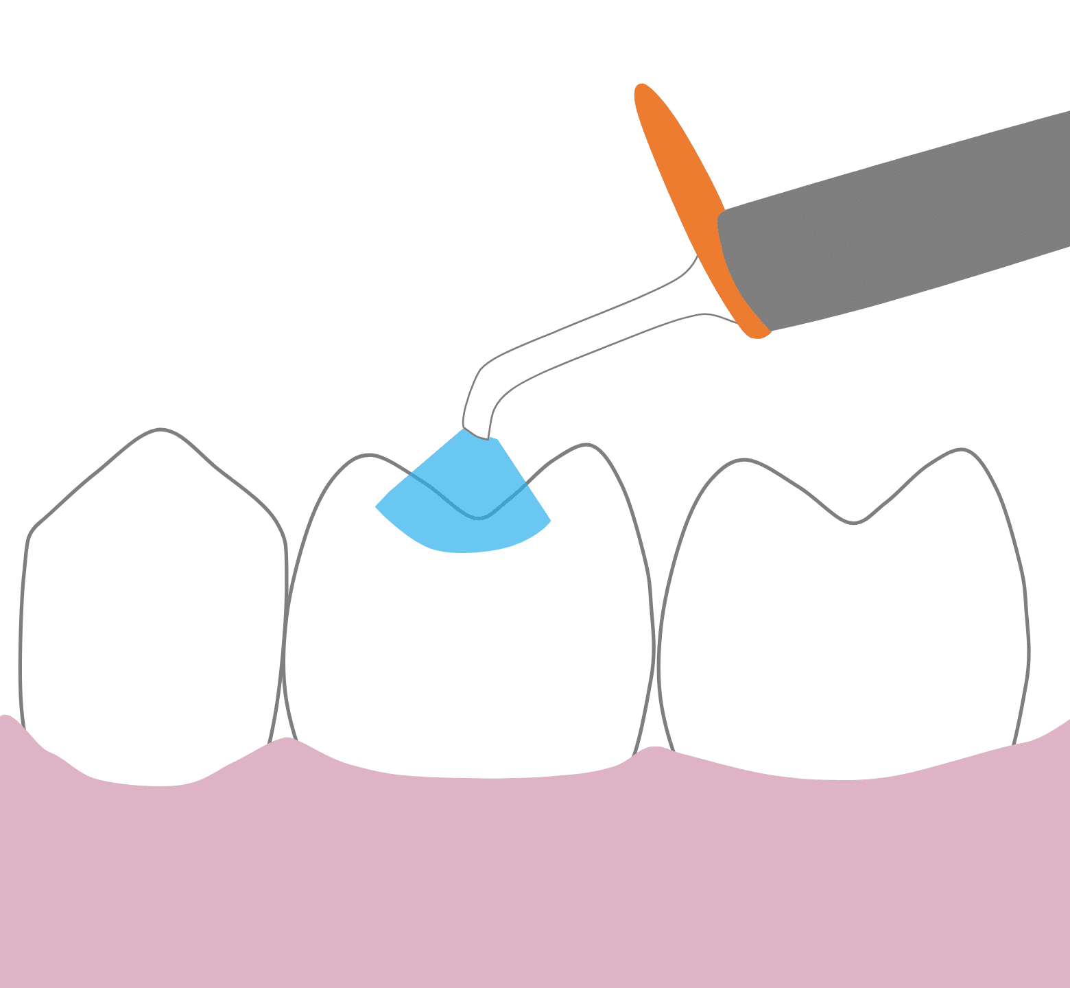White Fillings - Hampshire Dentists Pain Free Dentist in Southampton Graphic showing third stage of dental filling procedure