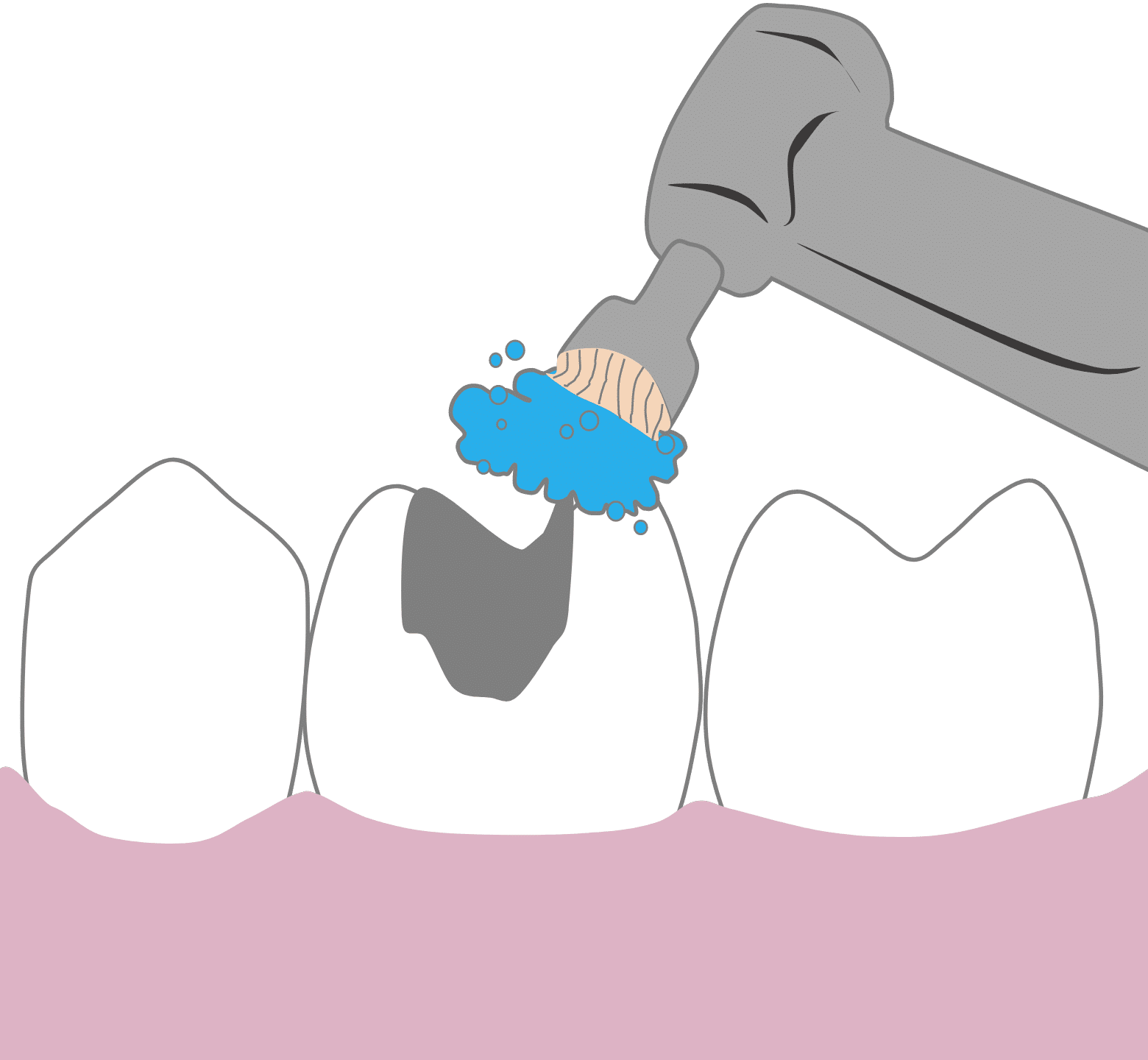 White Fillings - Hampshire Dentists Pain Free Dentist in Southampton Graphic showing first stage of dental filling procedure