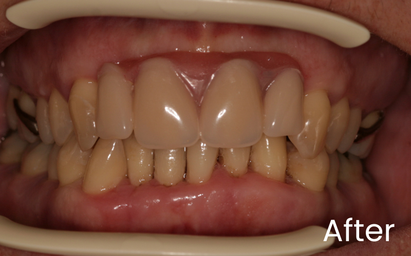 Front full retracted view of teeth with denture replacing front 4 teeth