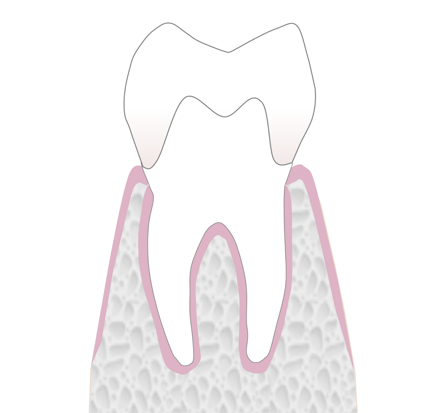 Graphic showing dental onlay
