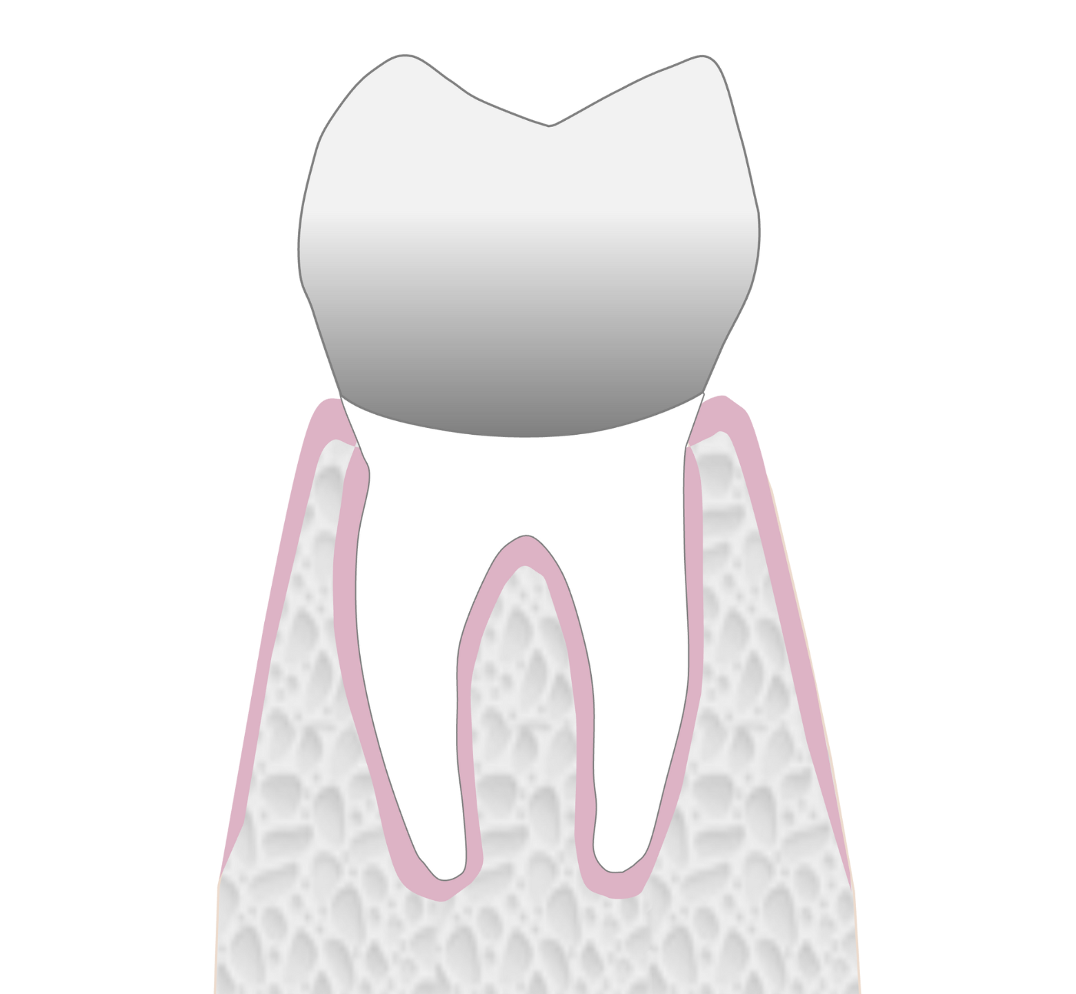 Graphic showing metal material dental crown