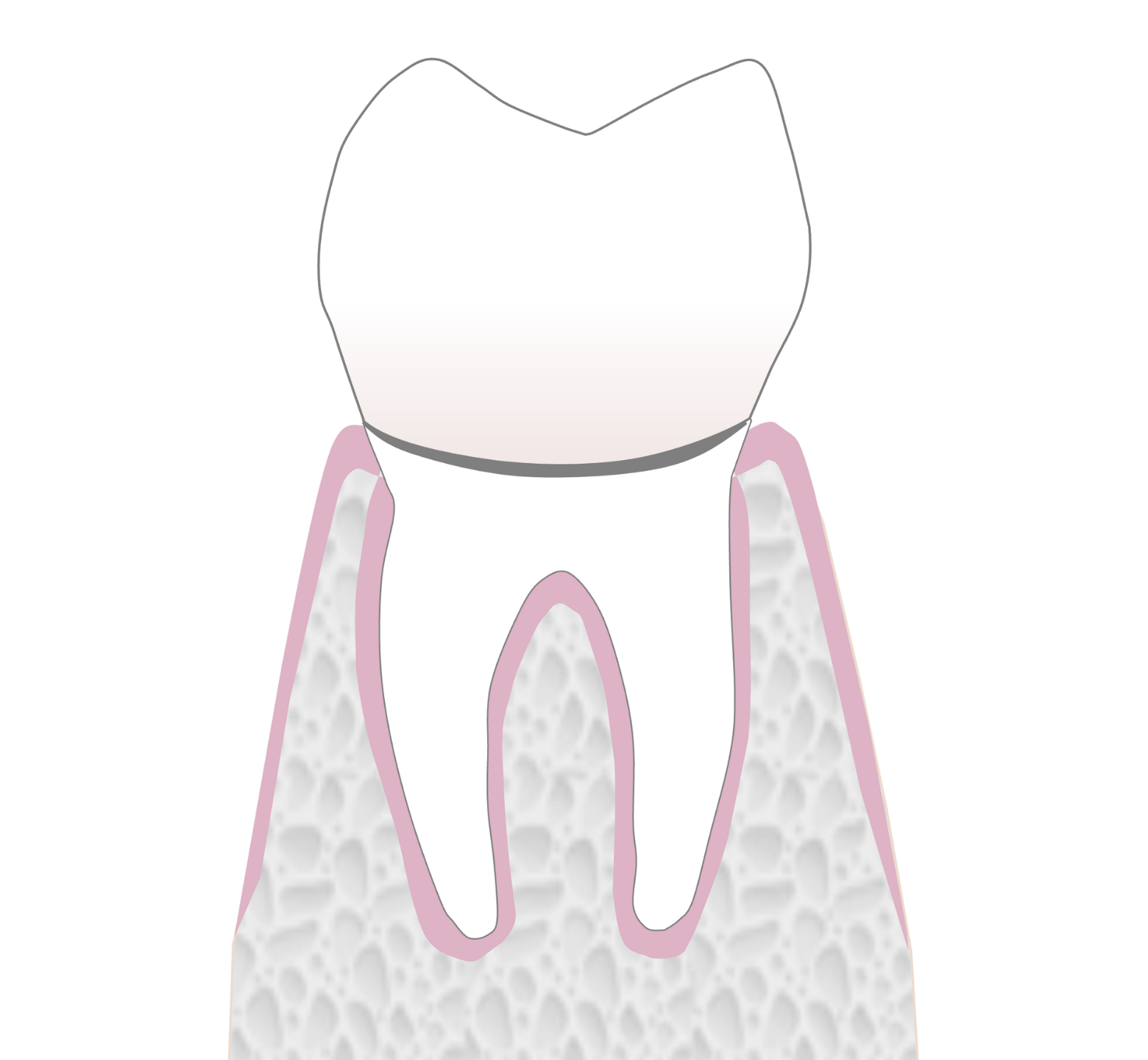 Graphic showing metal bonded to porcelain material dental crown