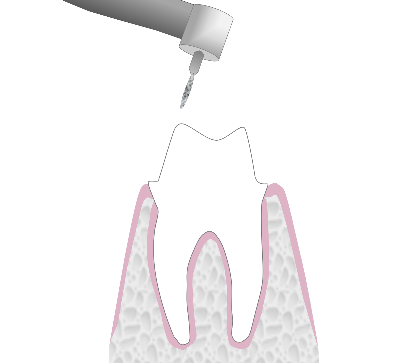 Graphic showing the first stage of dental crown treatment