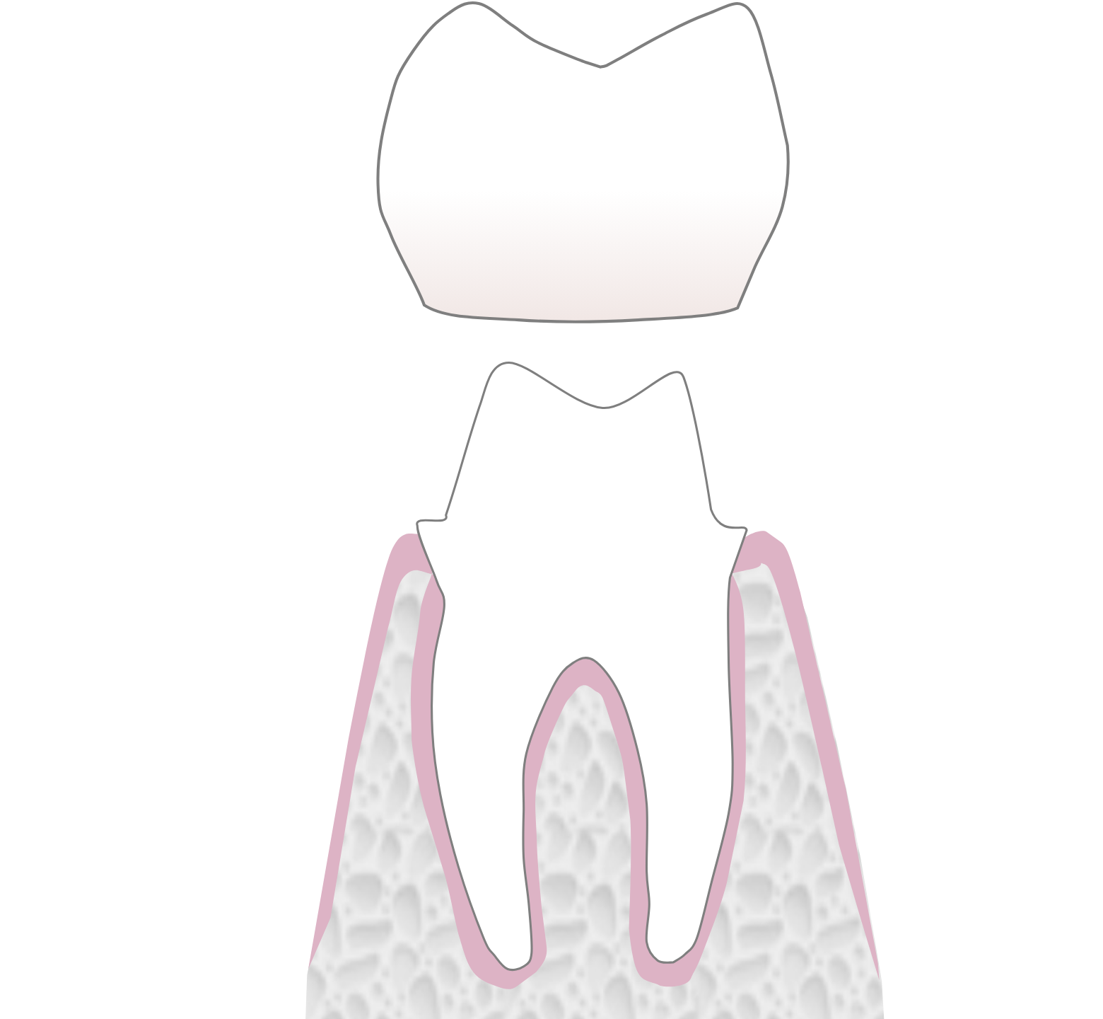 Graphic showing the second stage of dental crown treatment