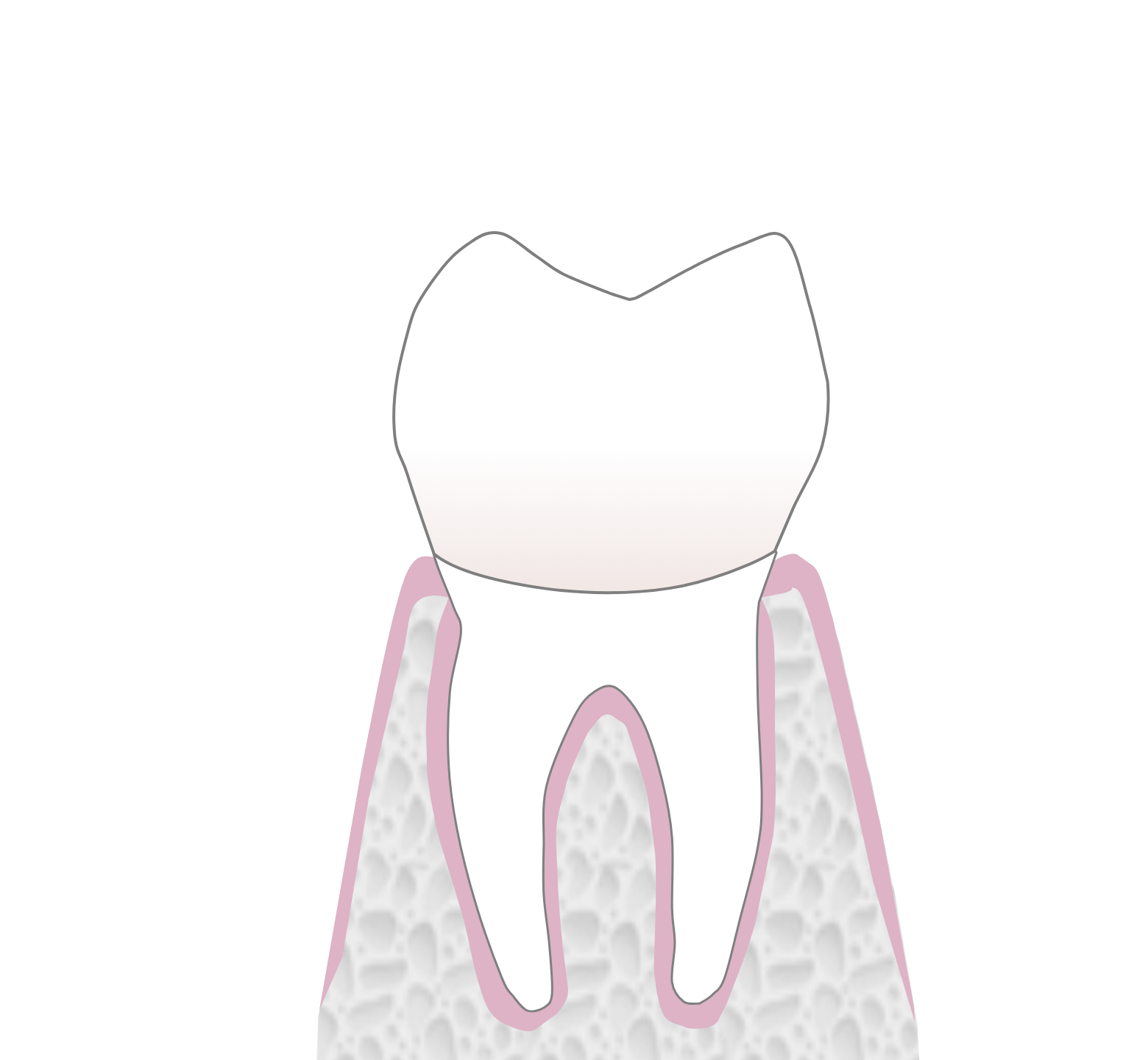 Graphic showing the third stage of dental crown treatment