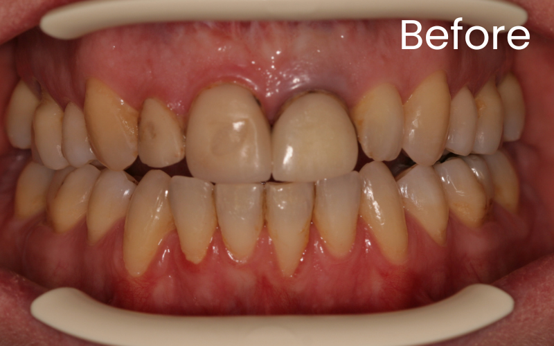 Front full image of teeth before dental crown treatment 