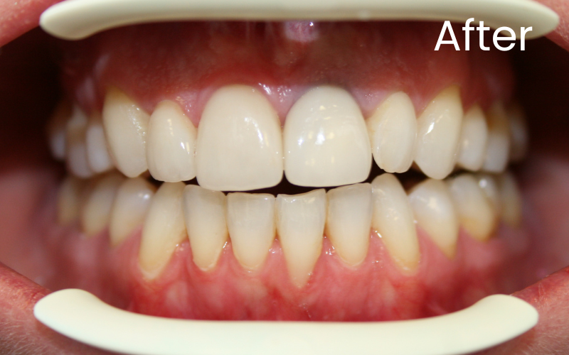 Front full image of teeth after dental crown treatment 