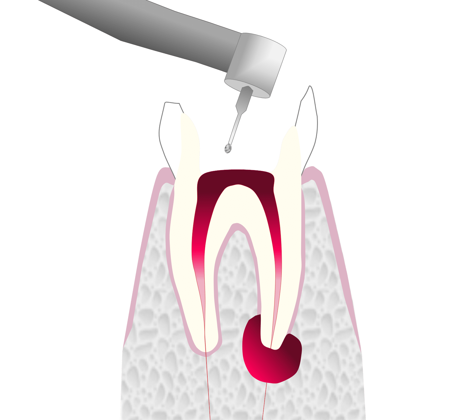Root Canal Treatment - Hampshire Dentists Pain Free Dentist in Southampton Graphic showing the first stage of root canal treatment