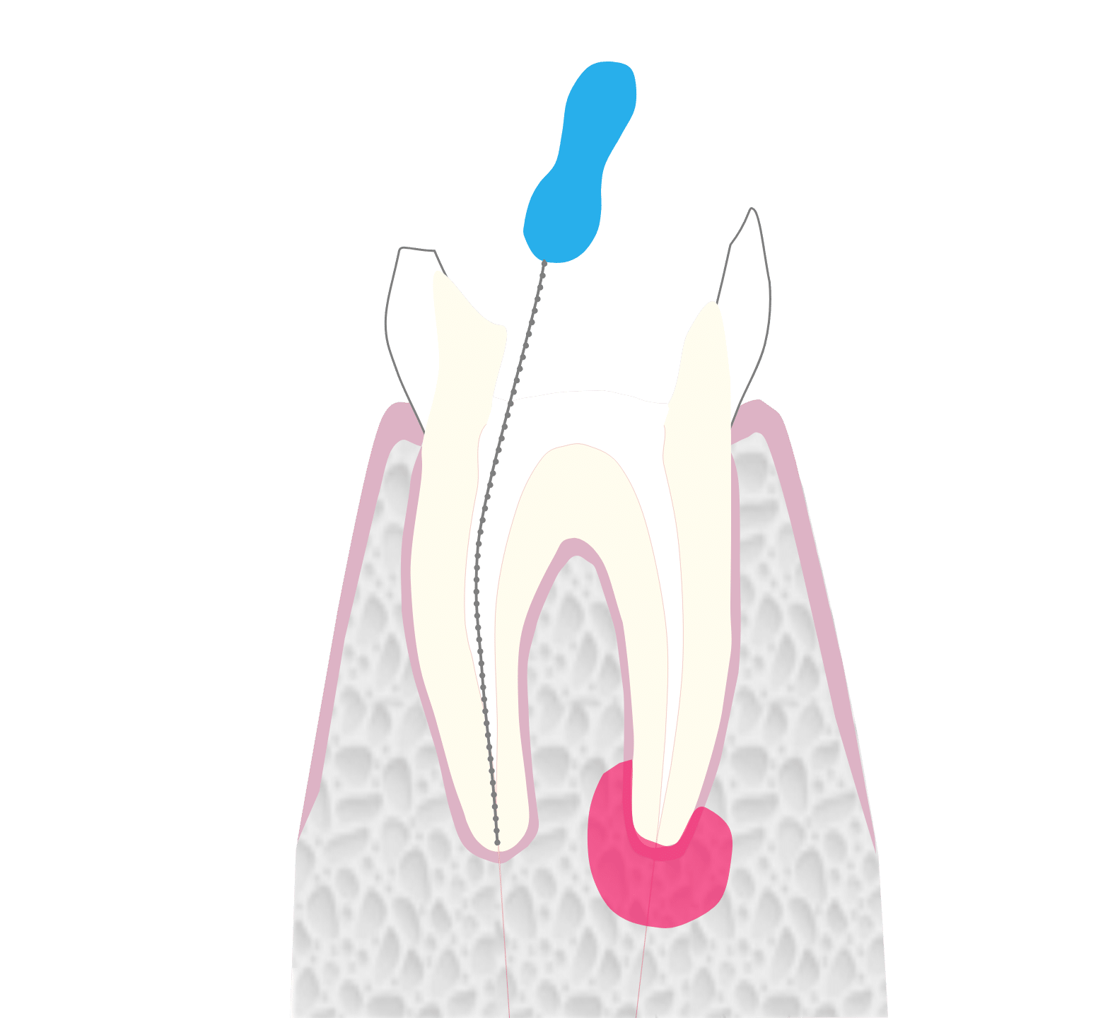 Root Canal Treatment - Hampshire Dentists Pain Free Dentist in Southampton Graphic showing the second stage of root canal treatment