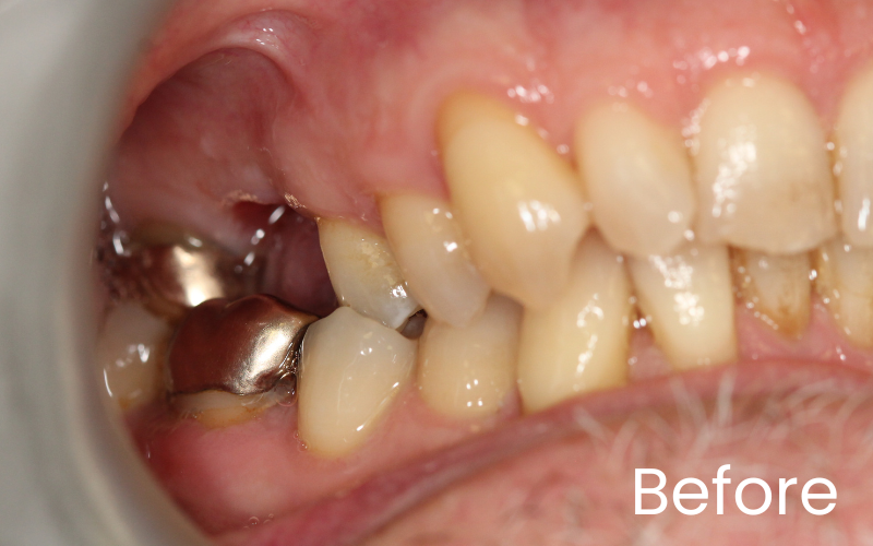 Teeth before dental implant treatment missing upper right back tooth