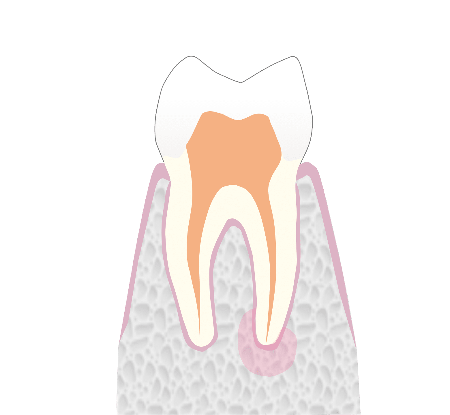 Root Canal Treatment - Hampshire Dentists Pain Free Dentist in Southampton Graphic showing the third stage of root canal treatment