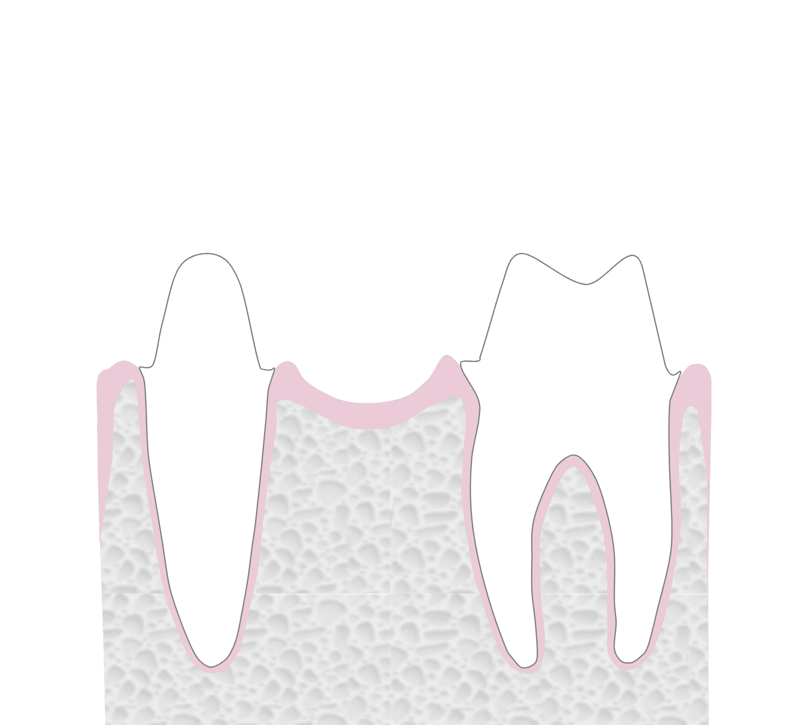 Dental Bridges - Hampshire Dentists Pain Free Dentist in Southampton Graphic representation of tooth preparation for dental bridge to replace missing back tooth