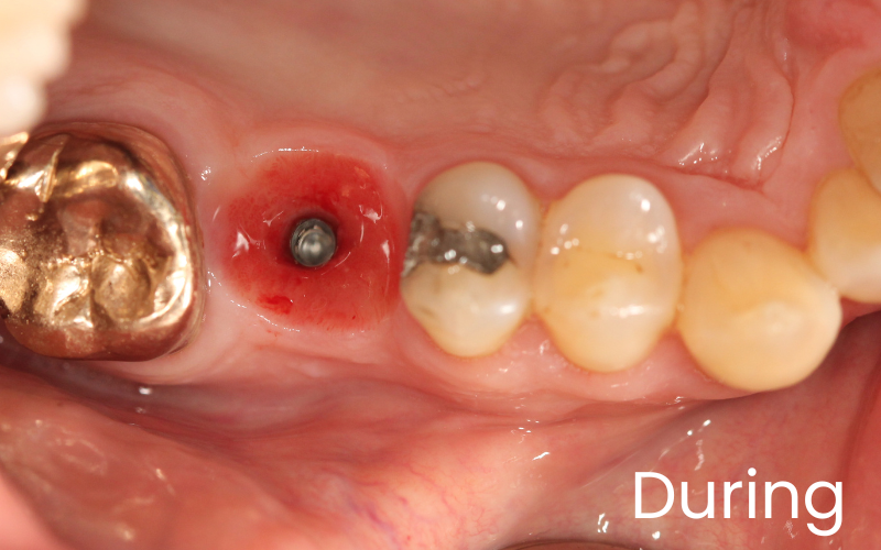 Close up image of dental implant sub structure placement treatment missing upper right back tooth