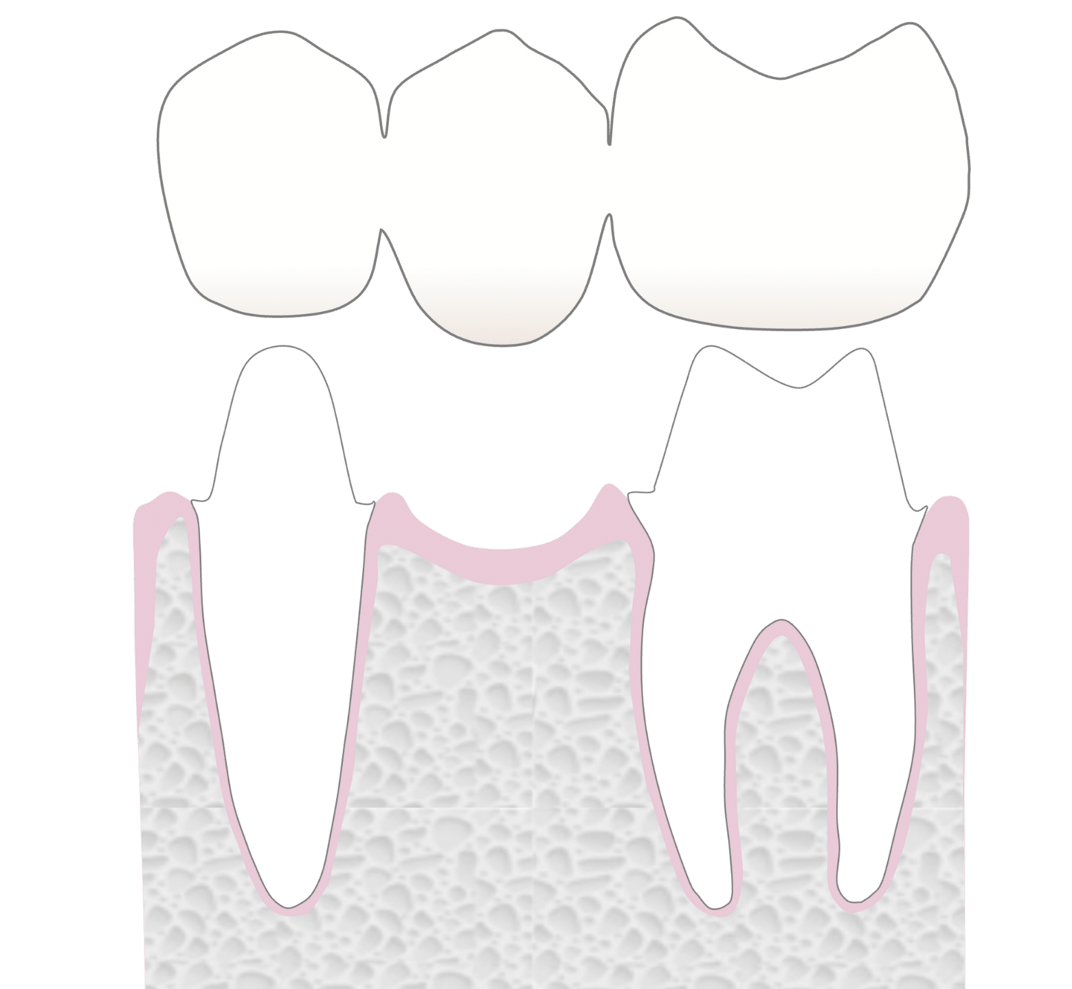 Dental Bridges - Hampshire Dentists Pain Free Dentist in Southampton Graphic representation of bridge being fitted onto prepared teeth to replace missing back tooth