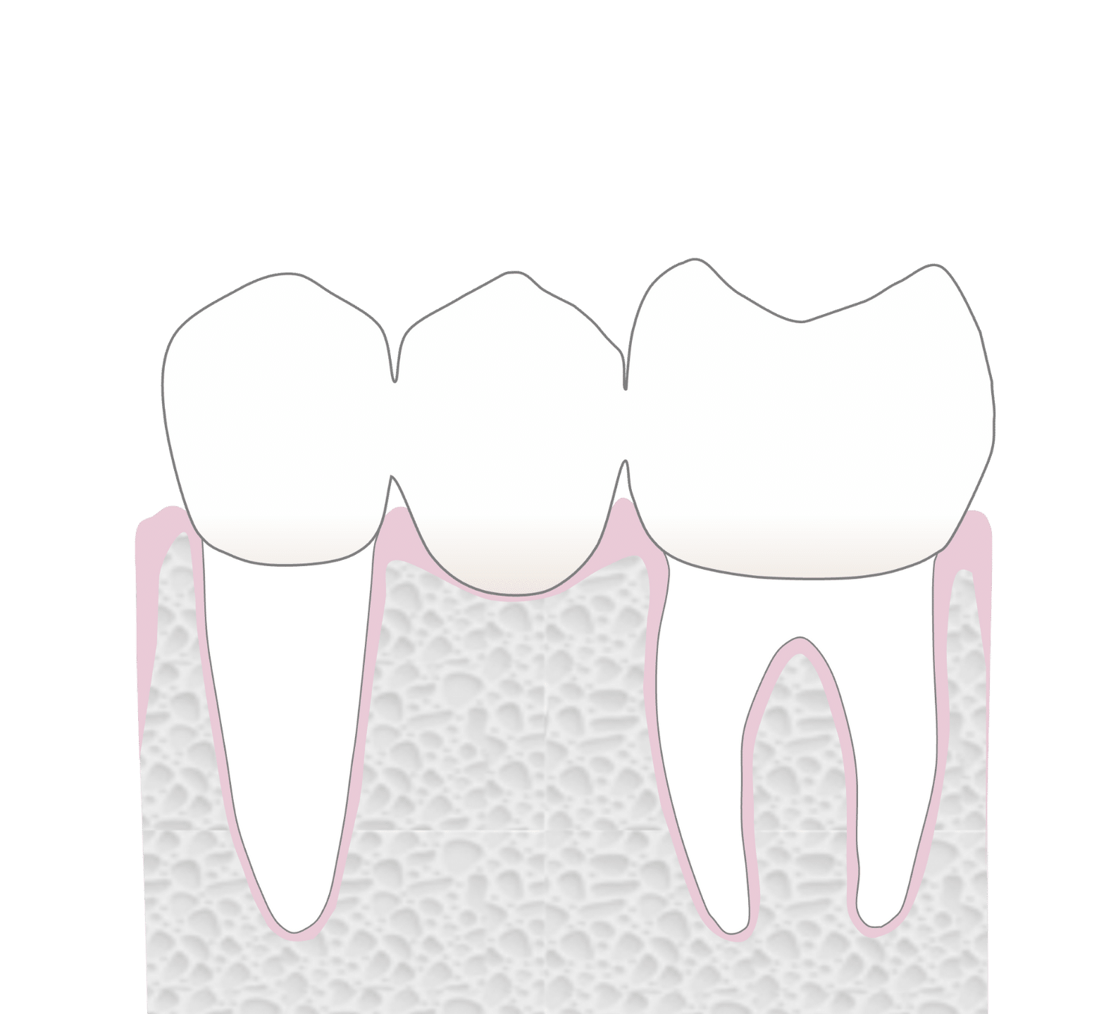 Dental Bridges - Hampshire Dentists Pain Free Dentist in Southampton Graphic representation of bridge fitted onto teeth to replace missing back tooth