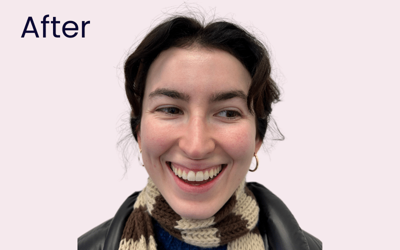 Invisalign - Hampshire Dentists Pain Free Dentist in Southampton Invisalign - Hampshire Dentists Pain Free Dentist in Southampton
