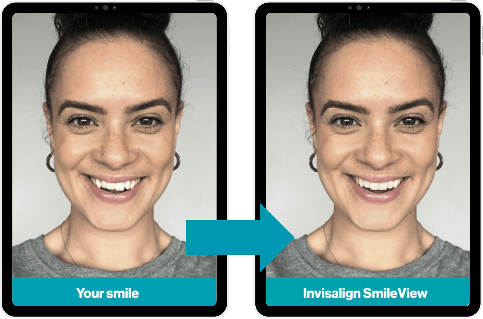 Invisalign - Hampshire Dentists Pain Free Dentist in Southampton Computer generated simulated transformation of smile with Invisalign Smileview on Ipad
