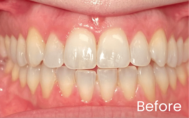 Invisalign - Hampshire Dentists Pain Free Dentist in Southampton Invisalign - Hampshire Dentists Pain Free Dentist in Southampton