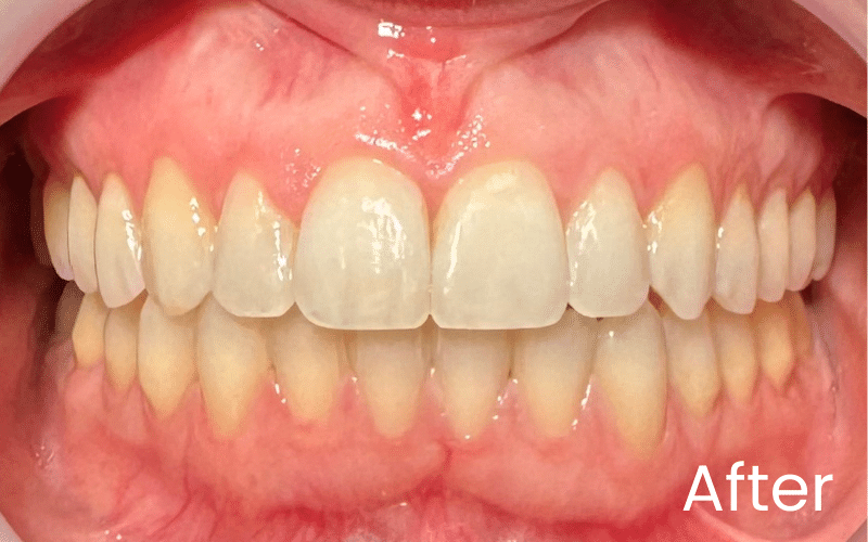 Invisalign - Hampshire Dentists Pain Free Dentist in Southampton Invisalign - Hampshire Dentists Pain Free Dentist in Southampton