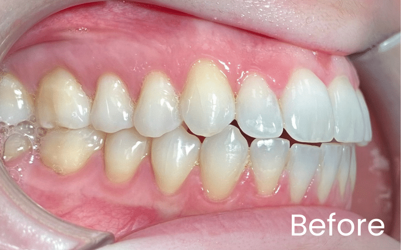 Invisalign - Hampshire Dentists Pain Free Dentist in Southampton Invisalign - Hampshire Dentists Pain Free Dentist in Southampton