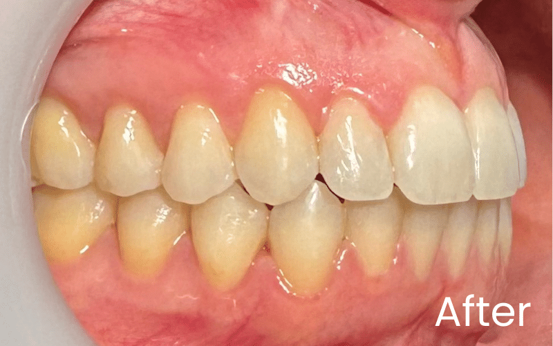 Invisalign - Hampshire Dentists Pain Free Dentist in Southampton Invisalign - Hampshire Dentists Pain Free Dentist in Southampton
