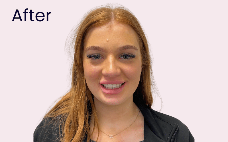 Invisalign - Hampshire Dentists Pain Free Dentist in Southampton Image of patient after teeth straightening with Invisalign