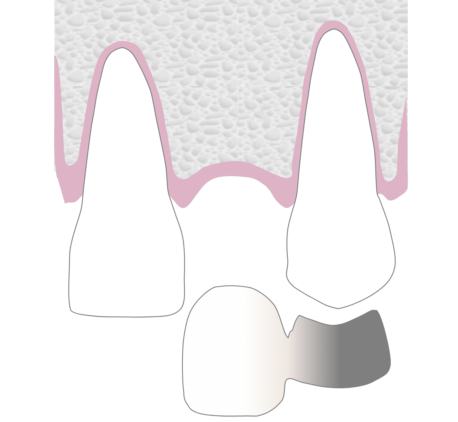 Dental Bridges - Hampshire Dentists Pain Free Dentist in Southampton Graphic representation of replacement of upper left front tooth with adhesive dental bridge