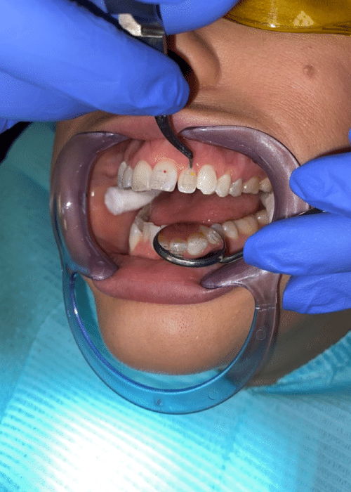 Fixed braces - Hampshire Dentists Pain Free Dentist in Southampton Close up view of the process of having braces fitted onto teeth