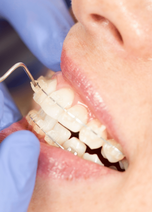 Fixed braces - Hampshire Dentists Pain Free Dentist in Southampton Close up view of the process of having braces adjusted