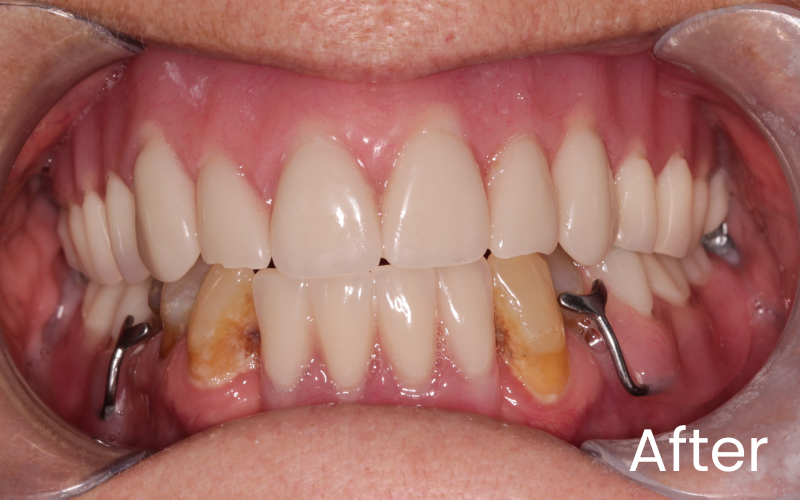 Full front retracted view of smile transformation with dentures