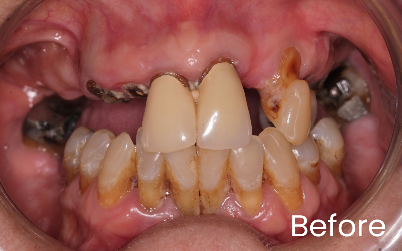 Full front retracted view of all teeth before transformation with dentures