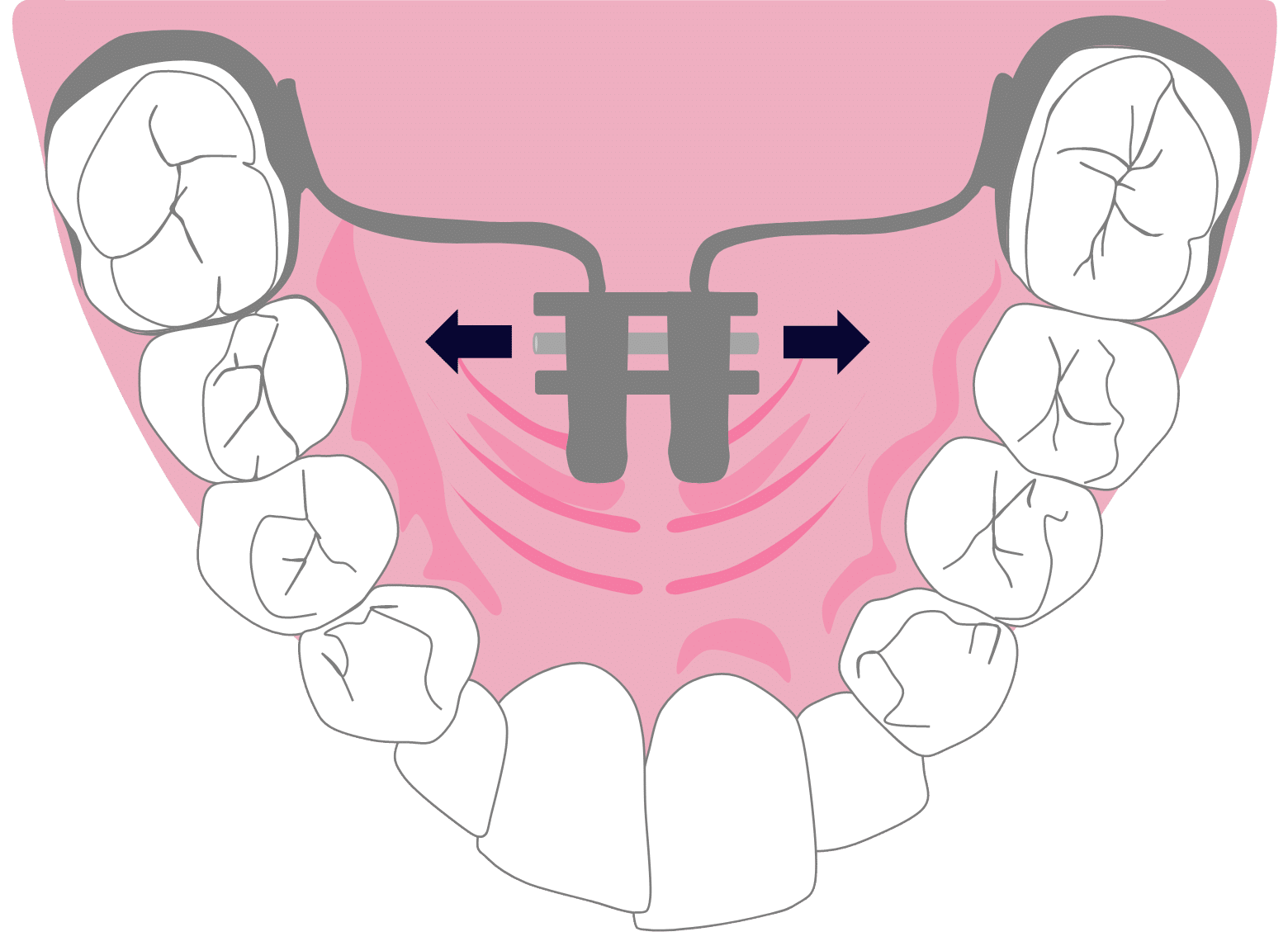 Children’s Braces - Hampshire Dentists Pain Free Dentist in Southampton Graphic representing hyrax rapid palatal expansion fixed in place across the upper palate