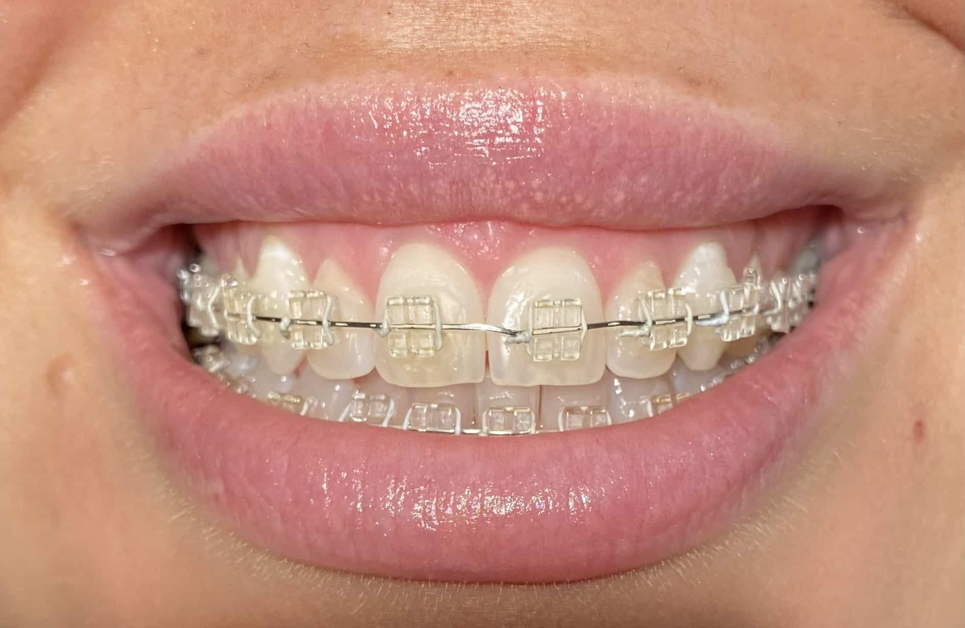 Fixed braces - Hampshire Dentists Pain Free Dentist in Southampton A woman smiling, showcasing her clear fixed braces, highlighting her dental treatment and confidence.